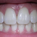 teethbig