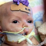Image via the CDC. Infant being treated for severe pertussis infection. She received extracorporeal membrane oxygenation (ECMO), a procedure that can take over the work of the lungs and heart. She also received dialysis to help her kidneys keep working.